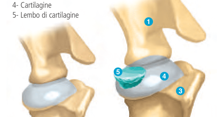 osteocondrite dissecante cane distacco cartilagine